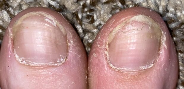 Horizontal Ridges On Toenails